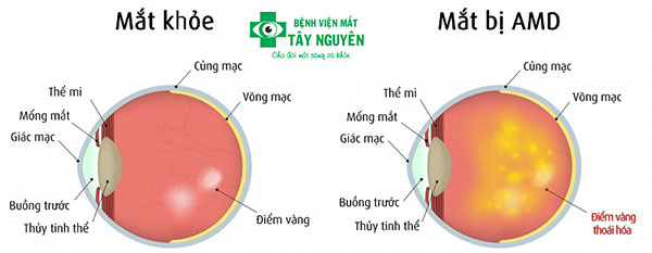 10 BỆNH LÝ NGUY HIỂM THƯỜNG GẶP NHẤT Ở MẮT AI CŨNG NÊN CẢNH GIÁC